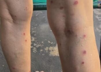 SURTO DE SARNA HUMANA EM CRECHES DE ESTRELA D’OESTE JÁ SOMA 80 CASOS