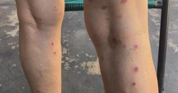 SURTO DE SARNA HUMANA EM CRECHES DE ESTRELA D’OESTE JÁ SOMA 80 CASOS